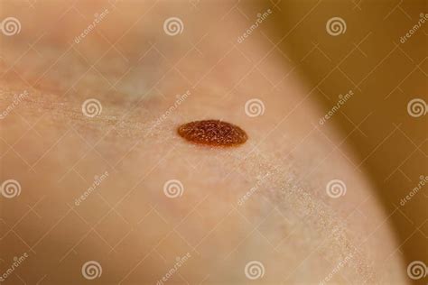 Closeup Brown Mole On Skin Stock Image Image Of Melanoma 188954091