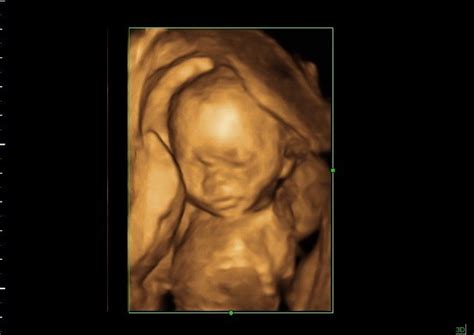 20 Weeks Baby In 3d Ultrasound 20 Weeks Baby Image In 3d U Flickr