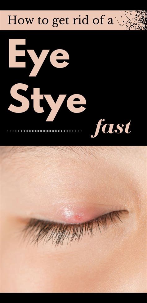 Learn How To Get Rid Of A Eye Stye Fast Eyestye Eye Stye Remedies