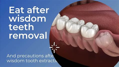 List Of Can I Brush My Teeth Days After Wisdom Teeth Removal