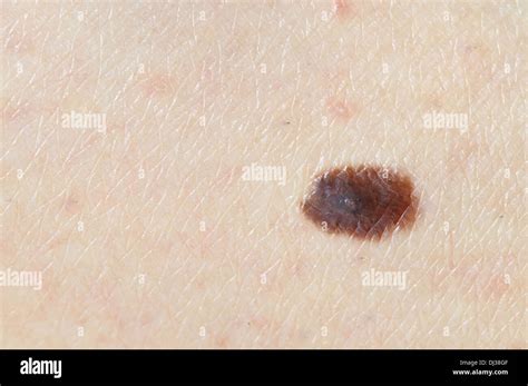 Close Up Of Brown Birthmark Nevus On Caucasian Woman Leg Stock Photo