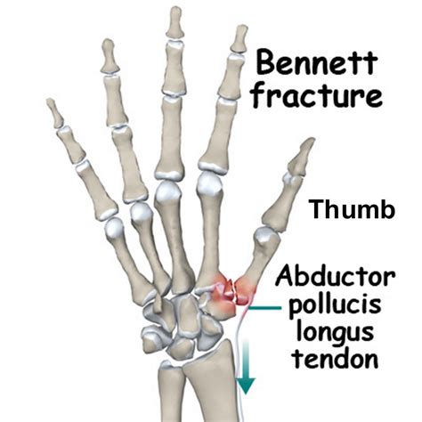 Bennett Fracture Causes Symptoms Diagnosis Treatment And Prognosis