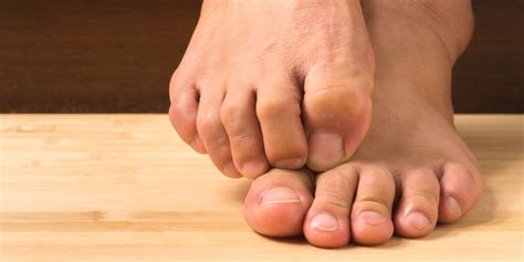 Overlapping Toes The Complete Guide Vive Health