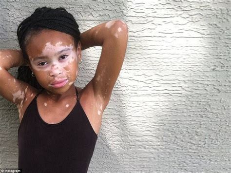 Young Model With Vitiligo Pushes Past Bullies To Redefine Beauty