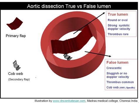 Aortic Dissection Table Dr S Venkatesan Md