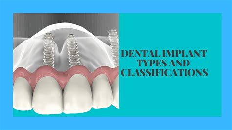 Dental Implant Identification Chart