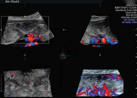 Placental Abnormalities Intechopen