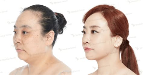 Buccal Fat Removal Everything You Need To Know About Cheek Fat