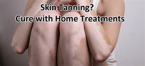 Cure White Spots On The Skin From Tanning Bed Allergy Gate