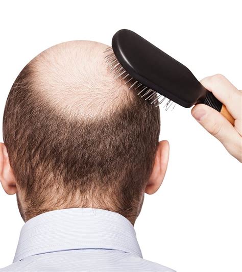 Hormone treatments can alleviate this hair loss if the problem is deemed severe by a doctor. What Is DHT Hair Loss And How To Treat It?