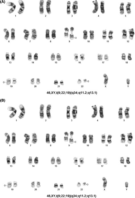Bone Marrow Chromosome Karyotypes A Cml Diagnosis The Diagnostic Download Scientific