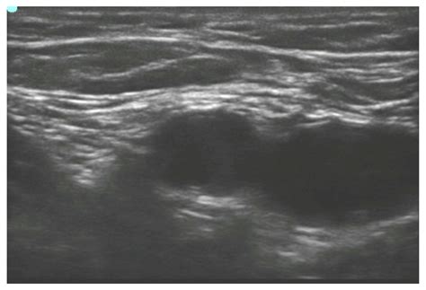 Ultrasound Guided Femoral Nerve Block Wfsa Resources
