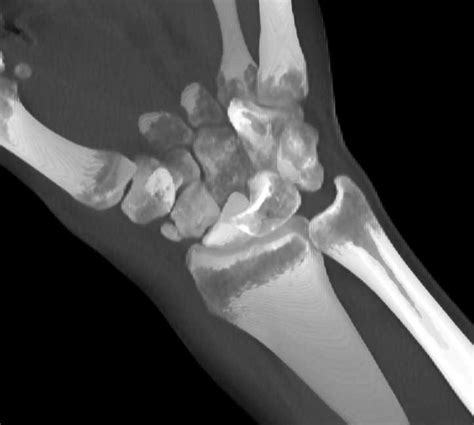 Fracture Dislocation Of The Carpal Bones Musculoskeletal Case Studies