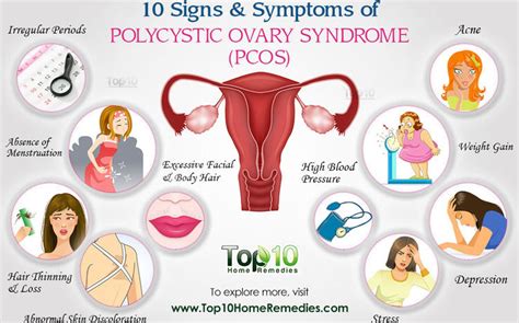 Understanding Polycystic Ovarian Syndrome The Herald