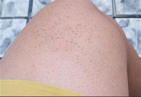 Strawberry Legs Easily Get Rid Of The Dark Spots On Your Skin Dr
