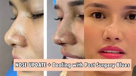 Nose Update Dealing With Post Surgery Blues After Rhinoplasty Jen