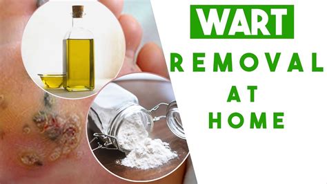 The Best Wart Removal At Home 100 Safe And Natural Youtube