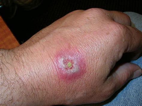 This usually occurs during a spider bite, although not all black widow bites contain venom. The Garden of Eaden: December 2012
