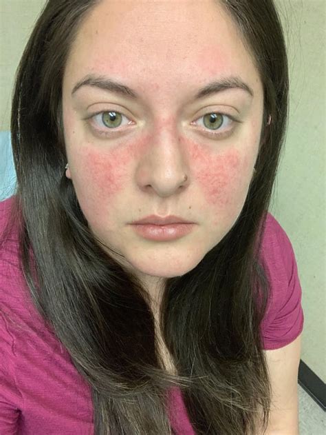 Possible Lupus Diagnosis Ive Had This Rash Forever But It Recently