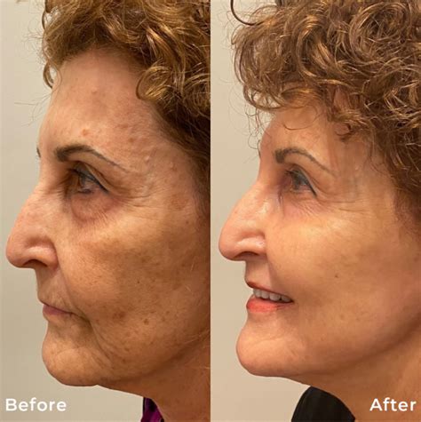 What Is Phoenix 15 Co2 Fractional Laser Resurfacing Rejuvayou Medical