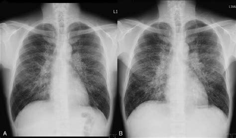 A Initial Chest Radiograph Showing Bilateral Hilar Enlargement And