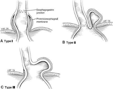 Open Paraesophageal Hernia Repair Basicmedical Key
