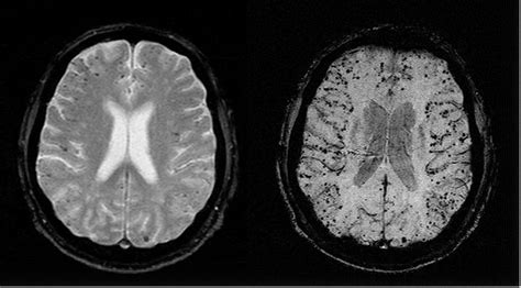 Imaging Cerebral Amyloid Angiopathy With Susceptibility Weighted