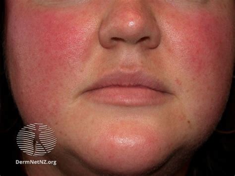 What Is Rosacea Rosacea Causes Triggers And How Estheticians Can Help