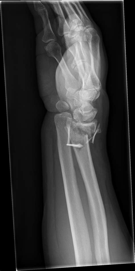 Intra Articular Distal Radius Fracture