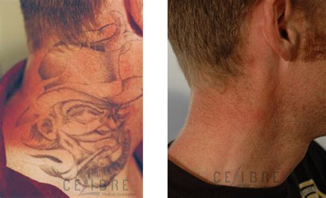 Laser tattoo removal is a complex process that a technician must evaluate on an individualized basis. How Does Laser Tattoo Removal Work?