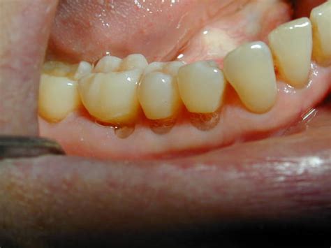 Abfraction — is the loss of tooth structure from flexural forces. Abfraction - DocCheck Pictures