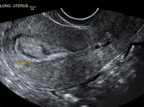 Endometrial Polyp With Coronal Us Medical Ultrasound Obstetric
