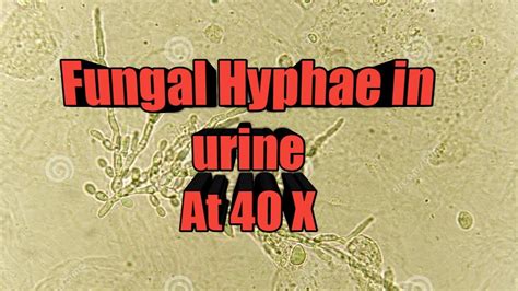 Fungal Hyphae In Urine Microscopy At 40x Youtube