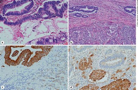 Figure 1 From Mixed Adenocarcinoma Carcinoid Collision Tumor Of The