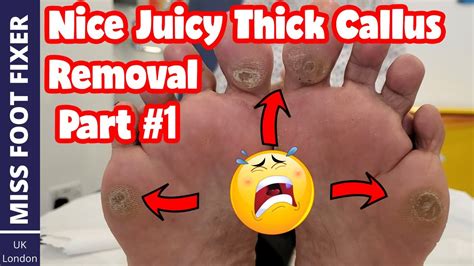 Part Nice Thick Juicy Callus Removal Full Treatment By Miss Foot