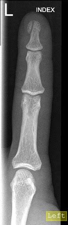 Distal Phalanx Fracture Radiology Reference Article Radiopaedia Org