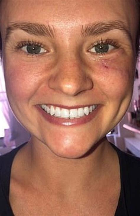 woman s tiny pimple under her eye was actually skin cancer gold coast bulletin