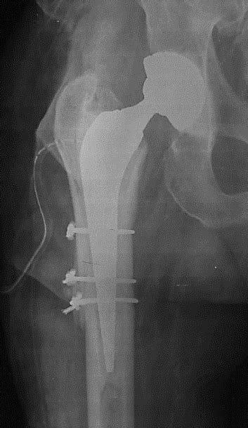 Postoperative X Ray Cemented Total Hip Replacement Was Performed With