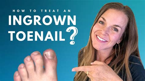 How To Treat An Ingrown Toenail Youtube