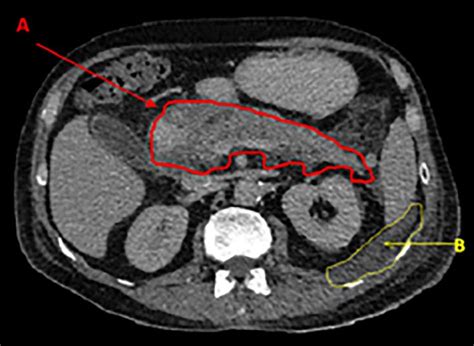 Contrast Ct Showing Inflamed Enhancing Pancreas A And The Presence