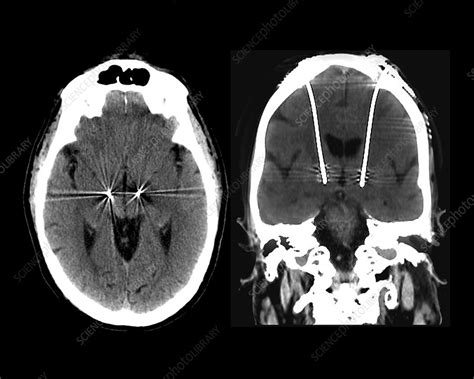 Parkinsons Disease Brain Stimulation Electrodes Ct Scans