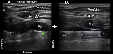 Ultrasound‐guided Retroclavicular Approach Infraclavicular Brachial