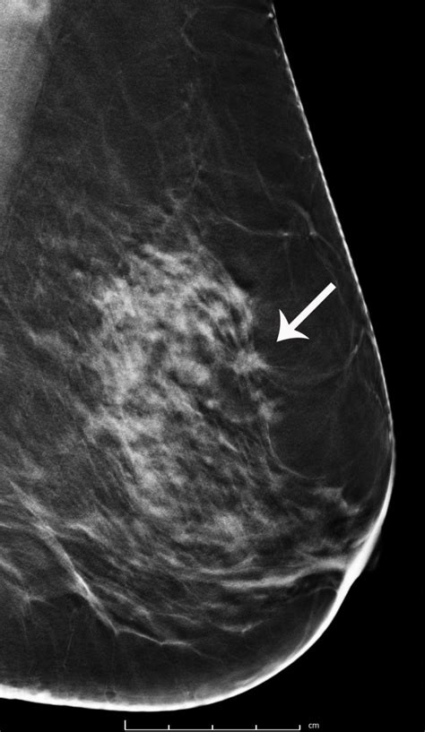 breast cancer screening with 3d mammography or tomosynthesis radiology and imaging ma ct