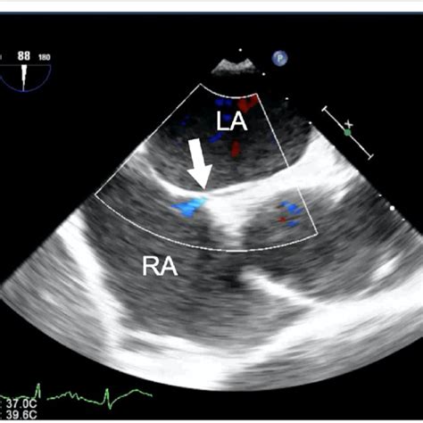 Transesophageal Echocardiography Showing A Patent Foramen Ovale And