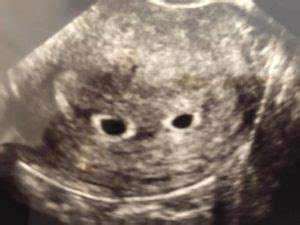 An ultrasound at 2 weeks won't show anything as it isn't big enough to be seen. 5-weeks-twin-ultrasound-5 - Twiniversity