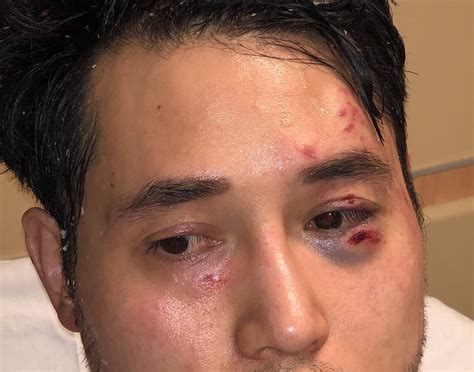 Antifas Brutal Assault On Andy Ngo Is A Wake Up Call—for