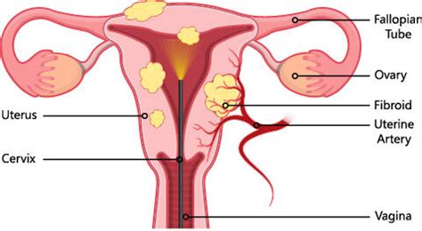 Myomectomy Obstetrics Gynecology Of Atlanta