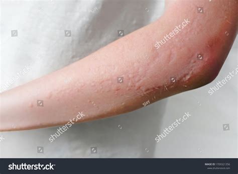 Skin Rashes Allergies Contact Dermatitis Allergic ภาพสต็อก 1709321356