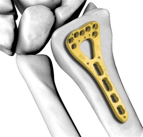 Orthopedic Implants Manufacturer Adding Gold To Titanium Enhances