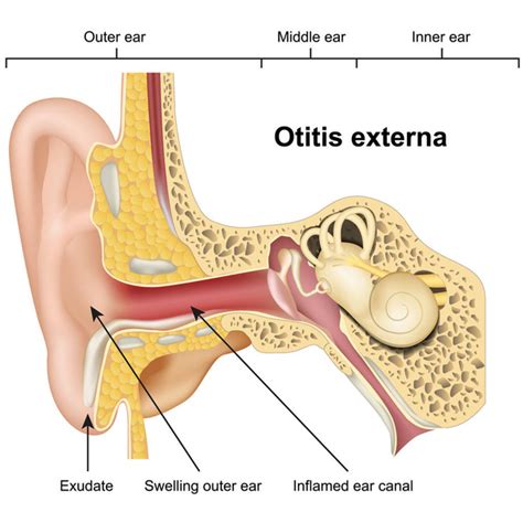 Otitis Externa Vector Photo Free Trial Bigstock Hot Sex Picture